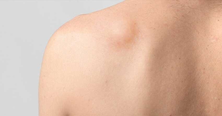 que-es-lipoma